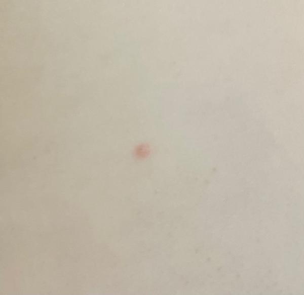 Červený fľak po vybratí kliešťa