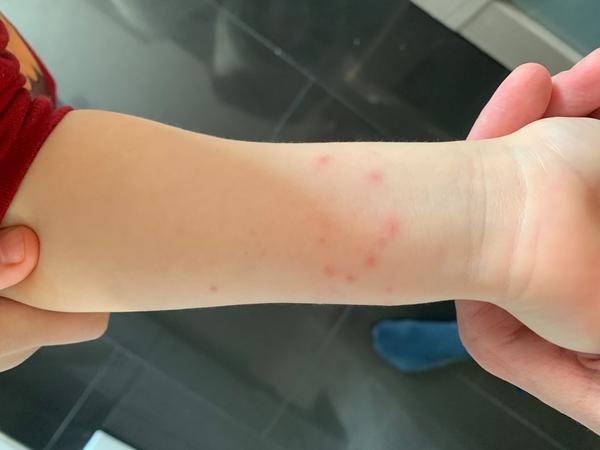 Vyrážky na predlaktiach dieťaťa: Ako ich liečiť?