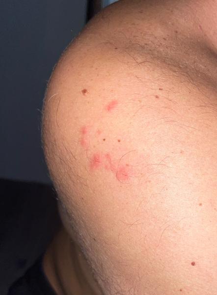 Môžu byť tieto štípance od ploštice?