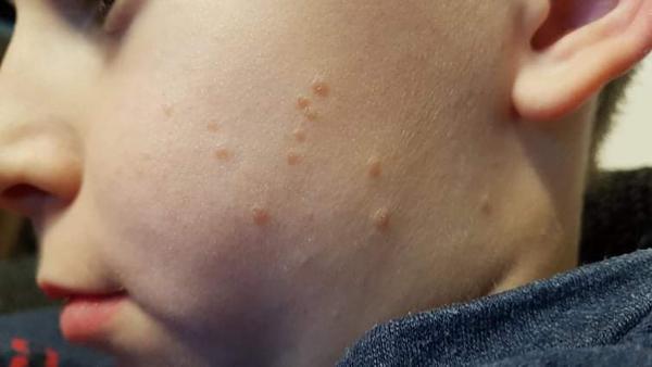 Ako sa nám podarilo vyliečiť vyrážky na tvári.