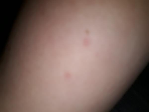 Aké ochorenie znamenajú tieto červené bodky?