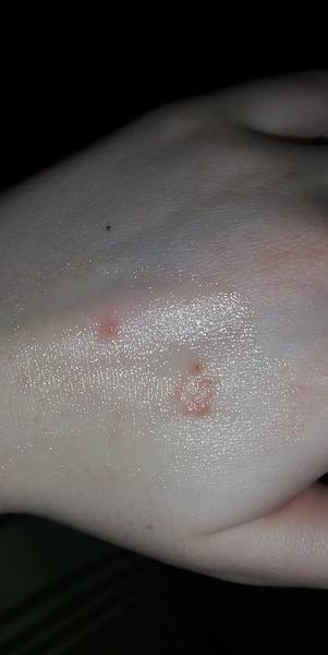 Kožné vyrážky na ruke