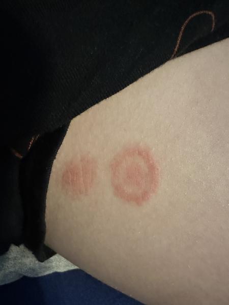 Aká masť na kožný problém?