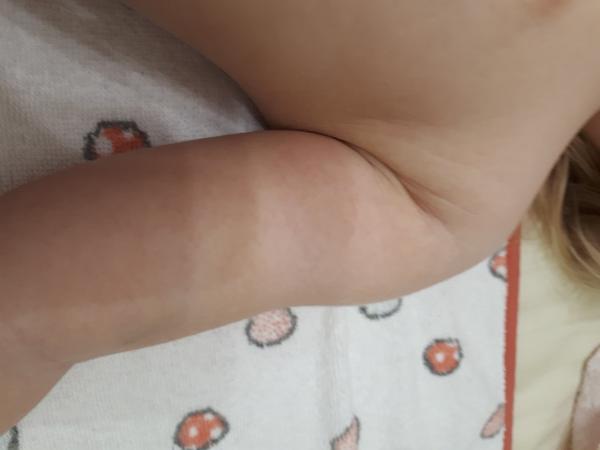 Silná alergická reakcia alebo vírusové ochorenie