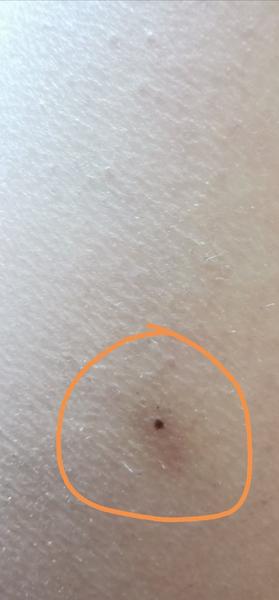 Okolo znamienka mám niečo hnedé. O aký problém ide?