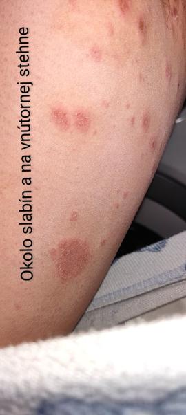 Vyrážky okolo slabín a podpazuší