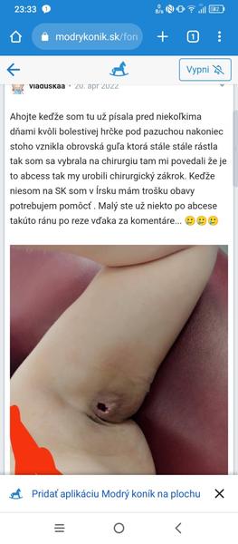 Absces sa mi hojí už dva mesiace