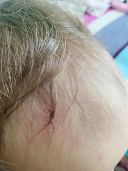 Ako riešiť škrabanec na hlavičke dieťaťa?