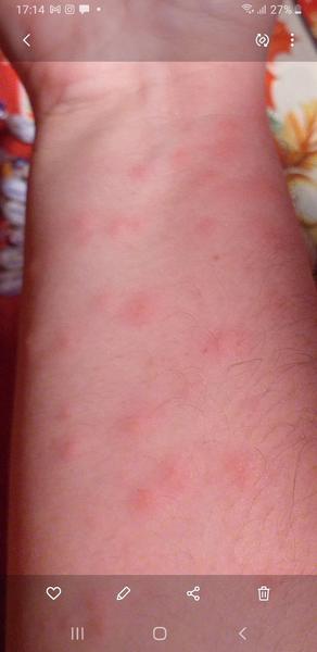 Vyražky na predlaktí pravej ruky.