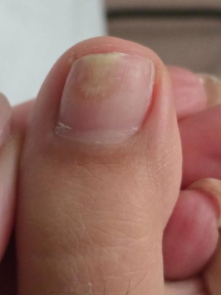 Ako sa zbaviť plesne na prste?