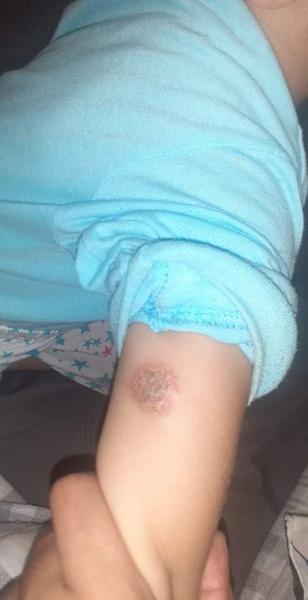 Aký kožný problém má môj synovec?