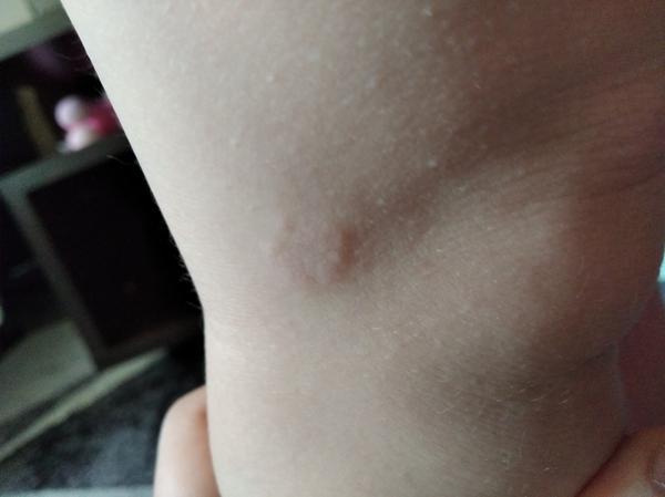 Čo znamenajú podkožné kolieska na nohách trojročnej dcéry?