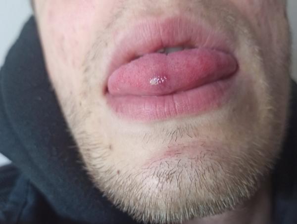 Mesiac mám vyrážku na jazyku