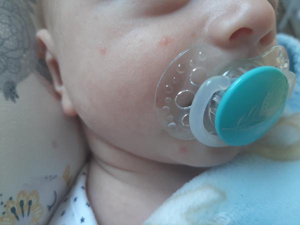 Vyrážky na tvári 6 týždňového bábätka
