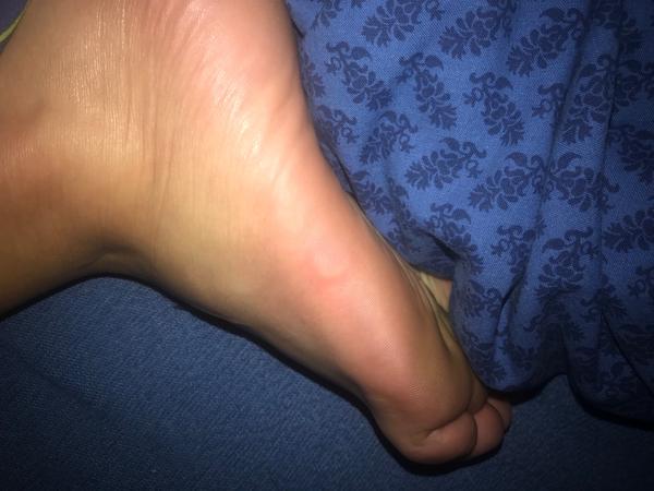 Aké červené fľaky sa mi vyhadzujú na chodidlách a na dlaniach?