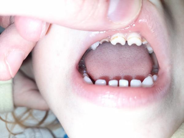 Aké oblúčiky má 2,5 ročná dcérka na vrchných zúbkoch?