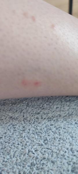 Sú toto štípance od ploštice?