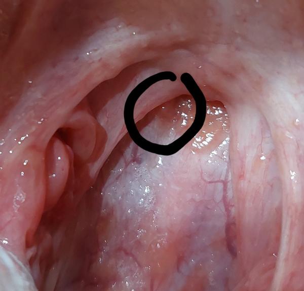 Čo sa mi to vytvorilo na stene hrdla?