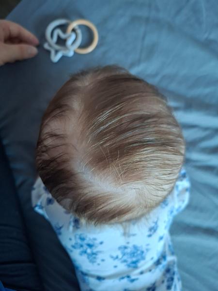 Skúsenosti so zlezenou hlavičkou u bábätka