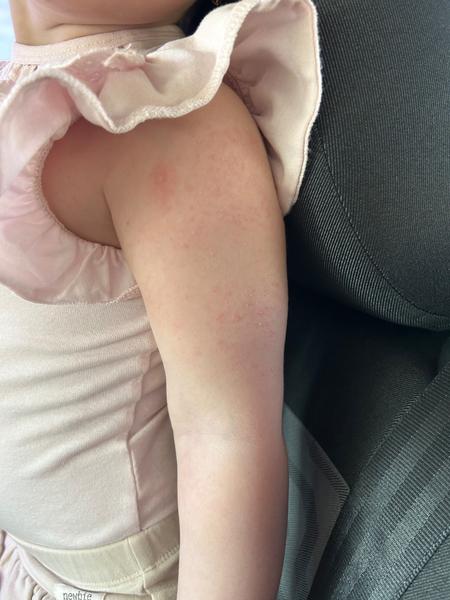 Ako vyliečiť vyrážky na ruke u dvojročnej dcérky?