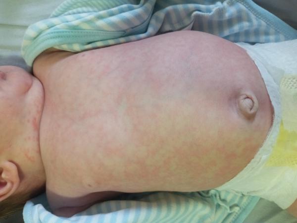 Výsyp na tele plne dojčeného 5 týždňového bábätka