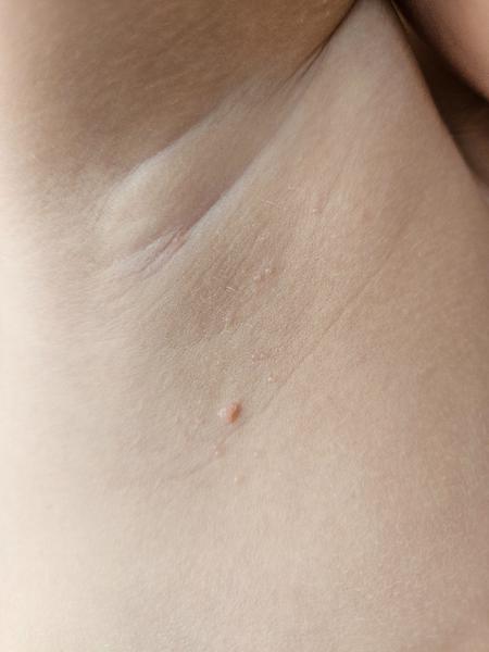 Čo spôsobuje hrbolce pod pazuchou?