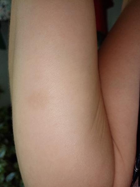 Aká škvrna sa mi urobila na ruke?