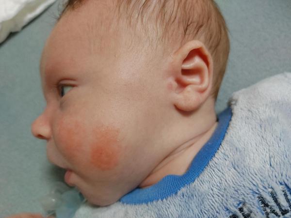 Ako pomôcť dvojmesačnému synčekovi, ktorý má výsyp iba na líčkach?