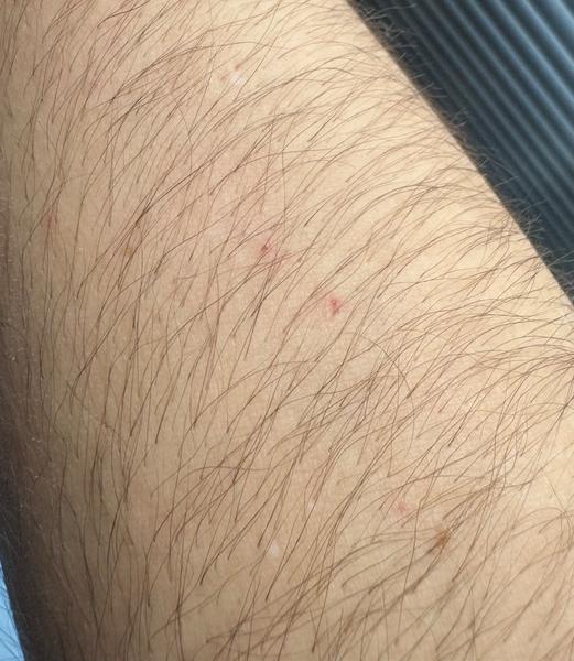 Ako zistiť, či ide o svrab?