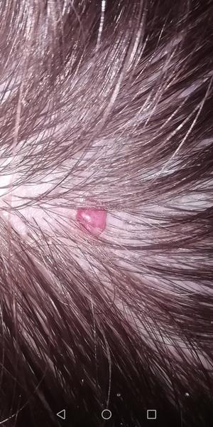 Ako sa dá odstrániť bradavica vo vlasoch tehotnej ženy?