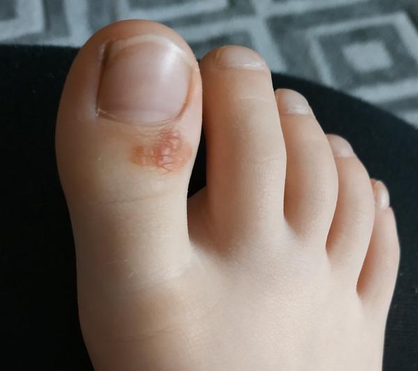 Červený fľak na palci na nohe