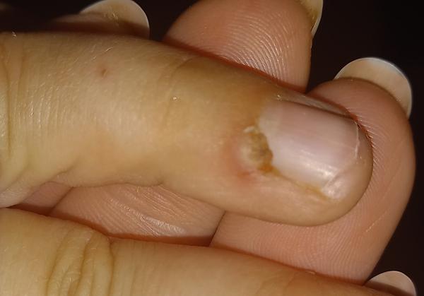 Čo to narástlo synovi na pršteku?