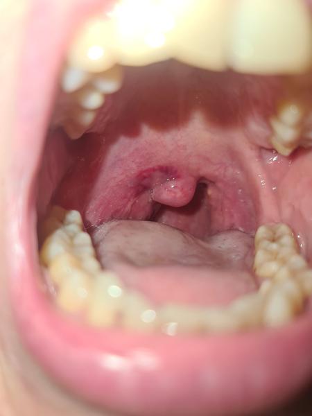 Skúsenosti s abscesom mandlí a liečbou antibiotikami