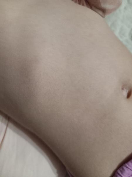 Vyrážky na tele u dcérky