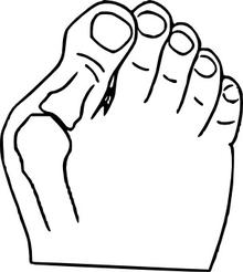 Hallux valgus - vybočený palec Hallux valgus - vybočený palec
