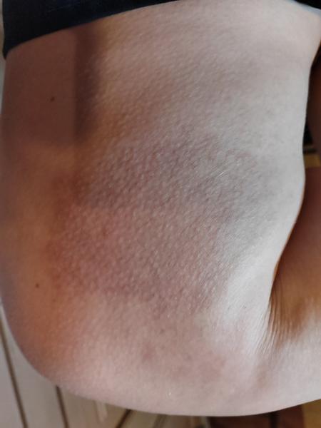 Uštipnutie osou: Ako liečiť opuch a bolesť?