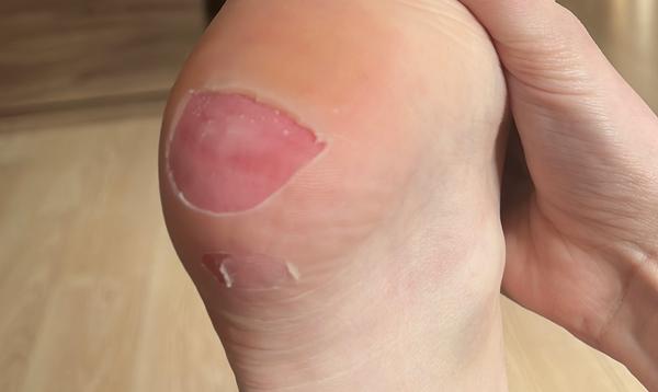 Mám ísť s pľuzgierom na päte k lekárovi?