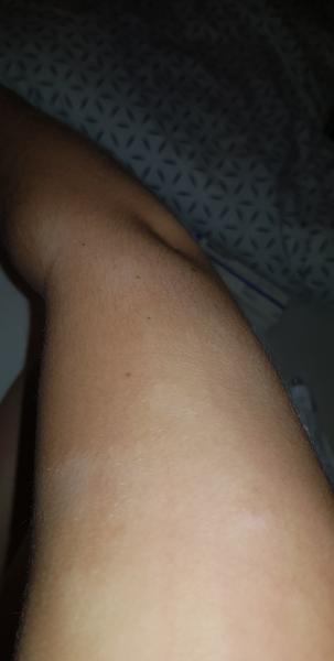 Stretli ste sa už s fľaky na koži, aké vidíte na obrázku ? 