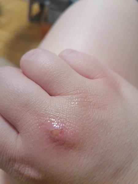 Musím ísť ukázať moju popáleninu lekárovi?