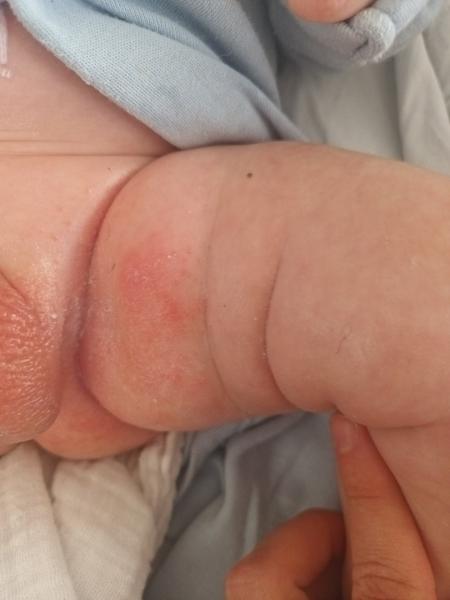 Výsyp u 2,5-mesačného bábätka