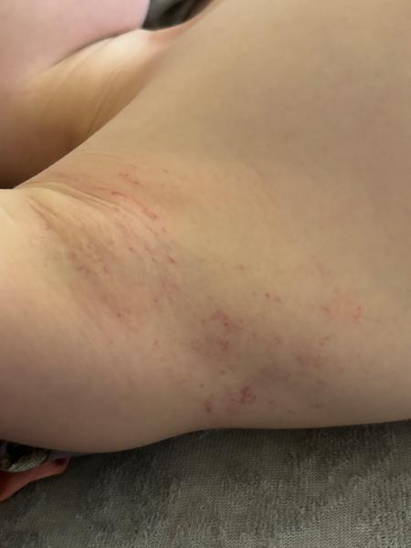 Krvavé fľaky v podpazuší: Čo to môže byť?