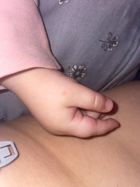 Sú to začínajúce kiahne?