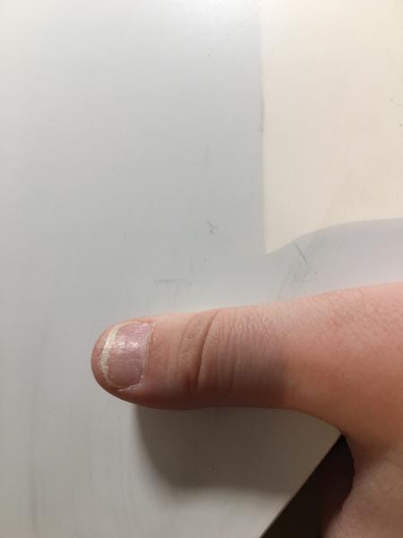 Ako liečiť psoriázu na nechtoch 7 ročného syna?