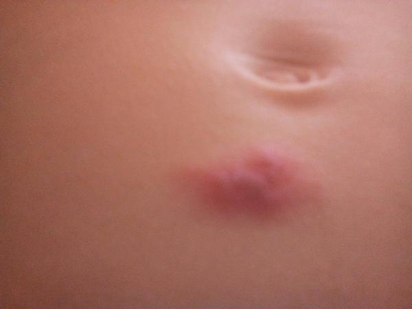 Vyrážka na brušku