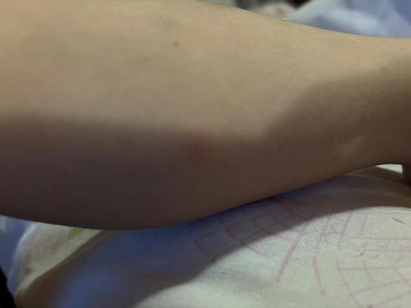 Môžu to byť kiahne?