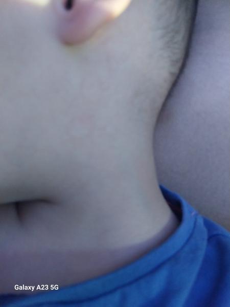 3-ročný synček má fľaky