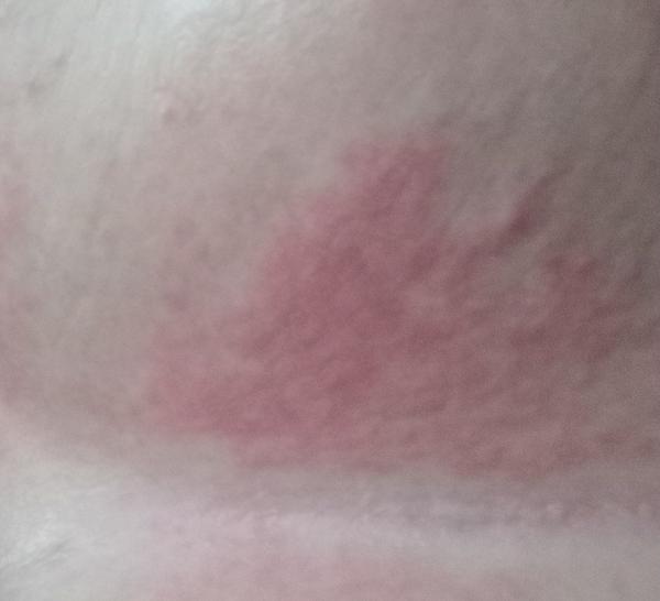 Červená vyrážka pod prsiami