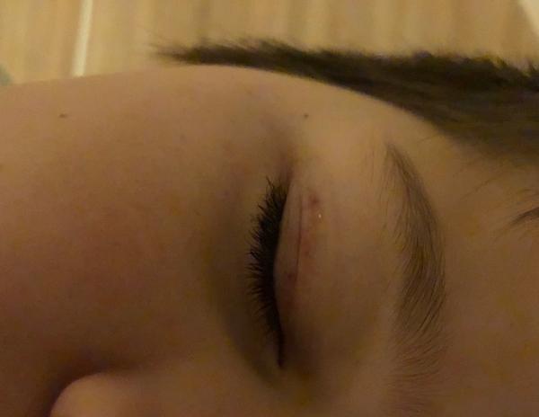 Čo to má moje dieťa na viečku?