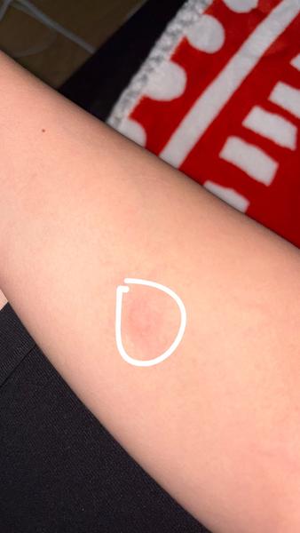 Opakujúce sa štípance na rovnakom mieste