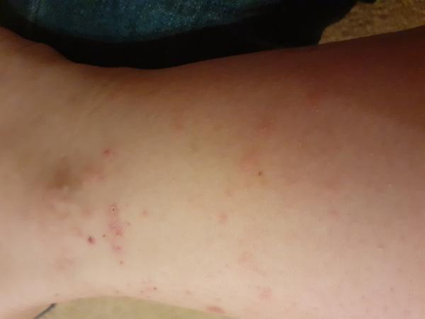 Čo pomôže proti štípancom?